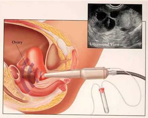北京医院供卵价格,北京甲亢网络咨询